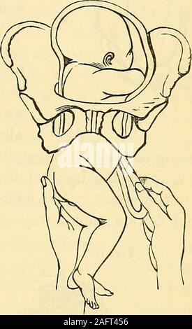 . Geburtshilfe: die Wissenschaft und die Kunst 102, zu sehen, wie er das Gesicht des Kindes machen würde des Beckens zu vorgeschriebenen Wenn er Tractions incautiously sollte auf: Dieschrauben der Fuß nur machen. Wenn er das Kind so weit wie der Nabel extrahiert, er tue, was in der abb. dargestellt wird. 103, das heißt, lassen Sie himcarefully eine große Schleife der Nabelschnur zu zeichnen, so dass nodanger Es brechen oder reißen sie es sich durch seine rootsat die Nabelschnur Ring entstehen können. Der Patient sollte jetzt auf herback gedreht werden, und der childs Beine sollten in eine Serviette eingewickelt werden, sicher zu holdthem. Sobald ein Go Stockfoto