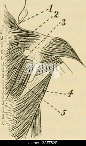 . Handbuch der operativen Chirurgie. cle, isolieren Sie ein geeignetes Bündel von seinen upperfibers; teilen diese isolierten Segment des Muskels an itshumeral einfügen und bilden so eine Klappe mit seinen pedicleposterior. Naht das Ende der Klappe theposterior Oberfläche der Schulterblatt unterhalb der Ursprung der thetriceps. Diese Klappe tritt an die Stelle der unteren Fasern ofthe gelähmt Trapezius (Abb. 1334). Zweite Stufe. - Durch die geeignete Schnittführung exposethe oberen Teil der gesunden (gegenüber) trapezius. Seine schlüsselbeinanteil einlegen und vorsichtig preserv Divide-ing die Nervenversorgung Form einen muskulösen Klappe und sutureit (Abb. 1335) t Stockfoto