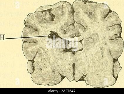 . Physiologische und Klinische Untersuchungen über das Gehirn, gesammelte Abhandlungen. Piff. 80.. Stockfoto