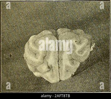 . Physiologische und Klinische Untersuchungen über das Gehirn, gesammelte Abhandlungen. Abb. 72. Stockfoto