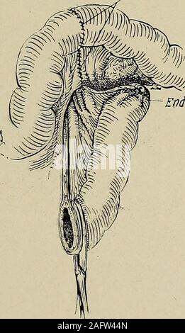 . Transaktionen der westlichen Surgical Association. Abb. 1 Darm dod Mesenterium dutured? .. Ende dosiert Schwein. 2 Stockfoto