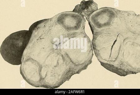 . Die Diagnose und die Behandlung von Krankheiten von Frauen. Ein J-Abb. 605. Mehrere Fibvomyomata der Gebärmutter. A. in der Gebärmutterhöhle. (Bischof-Uterinen Fibromyomaia.). Stockfoto