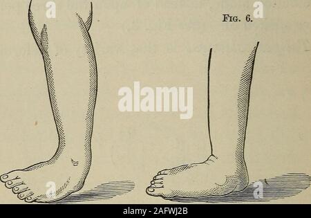 . Ein praktisches Handbuch für die Behandlung der Verein - Fuß. Talipes Calcaneus. wo Sie den vorderen Teil des Fußes erhöht wird, und die Ferse den Boden berührt. (Siehe Abb. 4.) In talipes Varus der Fuß ist invertiert und gedrehten moreor weniger in einer Weise, die 20 zu bringen Was ist TALIPES? Innere Fläche nach oben, den äußeren Rand zu einem great-er oder weniger auf der Erde. (Siehe Abb. (5) Abb. 5. Abb. 6.. Talipes Varus. Talipes Valgus. Talipes valgus präsentiert das Gegenteil von thiscondition, die innere Grenze des Fuß-Gemeinde. {Siehe Abb. 6.) Typische Beispiele für jede dieser Sorten oftalipes Stockfoto