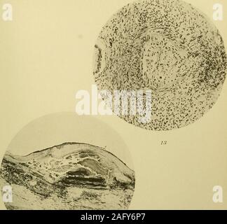 . Medizinische und chirurgische Berichte. Mallory Blutgefäße Platte X. IJ V i^iii&gt;^: ^ 1f1.^^^^W^Mallory Blutgefäße ansteckende Verletzungen von Blutgefäßen. 163 Beschreibung der Platten. Abb. 1. Organisierte thrombus in einer Arterie in der Niere, showingreplacement Der fibrin durch Fibroblasten. Abb. 2. - Organisation thrombus der Aorta. Das fibrin ist schwarz gefärbt. Die hellen Räume sind, Fibroblasten, die es nach und nach ersetzen. Abb. 3. - Akute infektiöse Läsion in der Wand der Arterie im Herzen von einem girleight Jahre alt, akute eitrige Arthritis sterben, aufgrund der streptococcuspyogenes und sekundär zu s Stockfoto