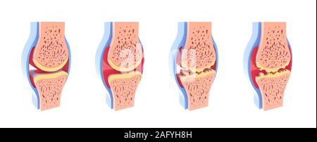 3D-Darstellung von Gesunden und sphärischen synovial Joint. In vier Darstellungen stehen und auf weißem Hintergrund. Stockfoto