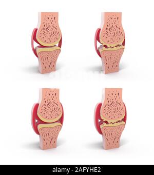 3D-Darstellung von Gesunden und sphärischen synovial Joint. In vier Darstellungen stehen und auf weißem Hintergrund. Stockfoto