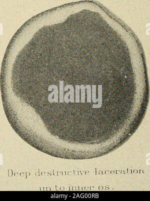 . Die Diagnose und die Behandlung von Krankheiten von Frauen. Abb. 439. Platzwunden und Erosionen des Gebärmutterhalses. {Ma, nn-amerikanischen System der Gynäkologie,) ZERREISSUNG DES CERVIX 293 Stockfoto