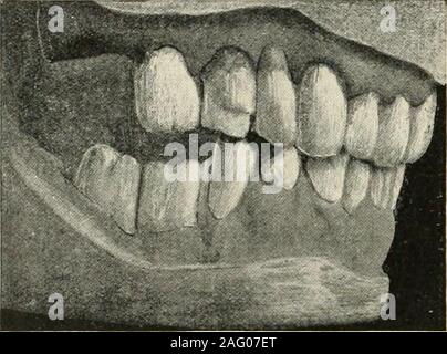 . Die Wissenschaft und Praxis der zahnärztlichen Chirurgie. e tatsächliche oder Relativ. Die toothmay tatsächlich aus seinem Sockel owingto Verlust der aU seine Gegner extrudiert werden. Aber wenn die ARCHIS teilweise durch künstliche Zähne auf einer Platte geliefert, und dieses gebiss langsam steigt oder sich in den Mund, die aufgrund der Druck exertedby gegenüberliegende Zähne und die allmähliche absorptionof Die alveolare Kante, die restlichen naturalteeth in die zusammengesetzte Bogen v, iR-becomerelatively länger als ihre künstliche Gefährten, obwohl keine eigentliche Extrusion von theirsockets aufgetreten ist. In diesem Fall werden Sie die Kraft der willencounter Biss soo Stockfoto