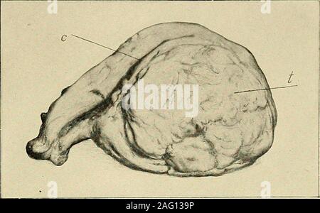 . Die Diagnose und die Behandlung von Krankheiten von Frauen. Leichte Erweiterung der Gebärmutter 245. Abb. 358. Eine einzelne myom, tlie posterioren Wand der Gebärmutter. (Byford-Manual für Gynäkologie). Stockfoto