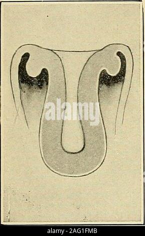 . Die Diagnose und die Behandlung von Krankheiten von Frauen. Abb. 316. Teilweise Inver-sion der Gebärmutter. Abb. 317. Submuköse Fib-roid mit langen PEDICLE. Abb. 318. Pediculated Fib? roid und partielle Inversion.. Stockfoto