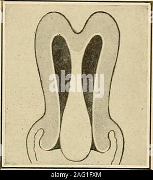 . Die Diagnose und die Behandlung von Krankheiten von Frauen. Abb. 316. Teilweise Inver-sion der Gebärmutter. Abb. 317. Submuköse Fib-roid mit langen PEDICLE. Abb. 318. Pediculated Fib? roid und partielle Inversion. Stockfoto