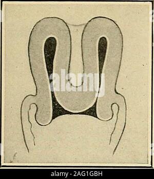 . Die Diagnose und die Behandlung von Krankheiten von Frauen. Abb. 315. Submuköse Fib-roid und Beginn der Inversion. Diagnose der Umkehrung der Gebärmutter 229. Stockfoto