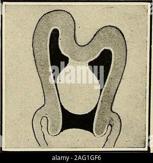 . Die Diagnose und die Behandlung von Krankheiten von Frauen. Abb. 314. Submuköse Fib-roid mit kurzen pedicle.. Abb. 315. Submuköse Fib-roid und Beginn der Inversion. Diagnose der Umkehrung der Gebärmutter 229 Stockfoto