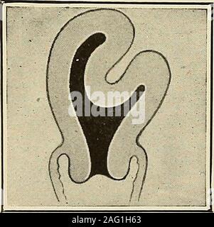 . Die Diagnose und die Behandlung von Krankheiten von Frauen. Abb. 312. Invertierung des Uterus, der Bildung: eine Masse in thevagina. (Kelly - Operative Gynäkologie). Abb. 313. Anfang Inver-sion der Gebärmutter. Stockfoto