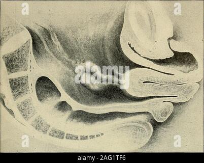 . Die Diagnose und die Behandlung von Krankheiten von Frauen. erativeGynecology.) PROLAPS von Blase und Gebärmutter 217. Abb. 292. Bandscheibenvorfall der Gebärmutter und Blase. (Doderlein und Was für ein schönes Geschwister Paar - Operative Gynakologie.) Stockfoto