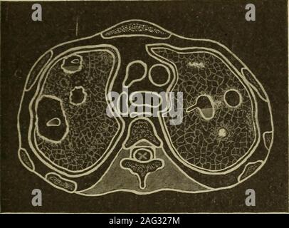 . Medizinische Diagnose für die Studierenden und Praktiker. inareas. Zyanose ist in der Regel gekennzeichnet und ist die Kombination von beschlossen, klinischen Wert in thepresence des Fiebers. Die UNTERSUCHUNG DER LUNGE UND PLEURAE 30 ICH Lungenödem. - Die primäre percussion Hinweis der Lungenödem ishyperresonant aber längere Zeit bei Fällen der Bereiche können Airless geworden und thebronchi rilled mit Flüssigkeit, in dem Ereignis oder sogar Ebenheit dulness bepresent kann wie im Fall von massiven Lungenentzündung. Ebenheit. - Diese typisch tot oder Tonlos Hinweis zeigt denseadhesions, flüssig Pleuraergüsse oder soliden Tumoren in enger Conta Stockfoto