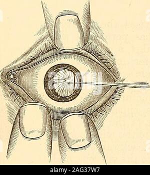 . Eine Abhandlung über die Krankheiten des Auges. s Erste durch Herrn Bowman/Andhas entwickelt, erwies sich als eine sehr wertvolle Ergänzung für die Ophthalmochirurgie. Sollten thefalse Membran gefunden werden aber leicht anhaftenden auf die Iris, so daß er sich frei in die Pupille floatsalmost, die verwachsungen kann durch die von der Nadel zerrissen, und die ganze Membran extrahiert durch eine lineare Schnitt durch die canulaor Kleine iris Pinzetten. Wenn die Verwachsungen gefunden werden so fest, dass eine gute Portion Kraft hätte beschäftigt werden, um sie zu brechen oder todivide, diese sollten auf keinen Fall versucht werden: aber die kostenlose portionshould gefangen werden durch Stockfoto