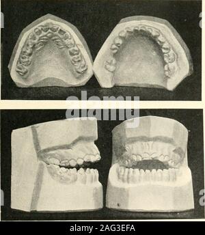 . Die Wissenschaft und Praxis der zahnärztlichen Chirurgie. Fio. 186.-Biss im Zusammenhang mit hypoplasie Öffnen. Molar occlusionlower post-normalen eine halbe Einheit. (Gorman G. Bennett.) der Zweiten Molaren, und er verbindet dies mit arapid Entwicklung der Zunge, occasionedby seines übermäßigen Einsatz in der Kaumuskulatur an diesem Bild. 187.- Portrait von Fall in Abb. 1 gezeigt. 186. Das Wachstum der Zunge kann zu öffnen biteapart von anderen Bedingungen. Es kann saidthat Teil der Sim-Wallaces explanationappears werden eher weit hergeholt, becauseas eine Regel der Ausbruch des secondmolars zu wenig oder keine incon gibt - und dass venience Stockfoto