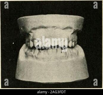 . Die Wissenschaft und Praxis der zahnärztlichen Chirurgie. Abb. 184. - Biss im Zusammenhang mit liypoplasia Öffnen, anterior Gingivitis, Adenoids und kleinen Rachen. Normale molare occUision. (Norman G. Bennett). Stockfoto