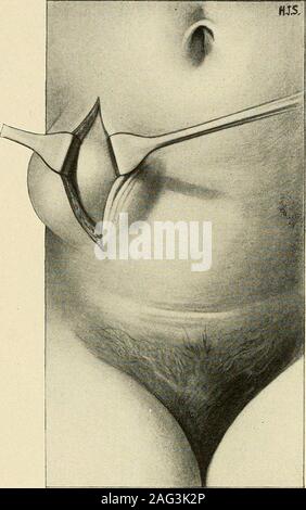 . Die Diagnose und die Behandlung von Krankheiten von Frauen. Abb. 123. Adipositas, für Schwangerschaft durch pa - Tient verwechselt. (Williams - Geburtshilfe.) 122 gynäkologische Diagnostik. Abb. 124. Ein Tumor der Bauchwand. (Montgomery - Praktische Gynäkologie.) den Betrieb auf eine vermeintliche strangu-ventrale Hernie. Die patientgave die Geschichte eines langen - standingswelling einigen Abstand zu den oben im Fahrerschutzdachund heterozygotie. Diese suddenlyenlarged und wurde schmerzlich, begleitet theenlargement byabdominal Schmerzen, Erbrechen, Con-stipation und Beweise der inflam- tionen in der Masse. Die patientwas vor einem medizinischen classfor op Stockfoto