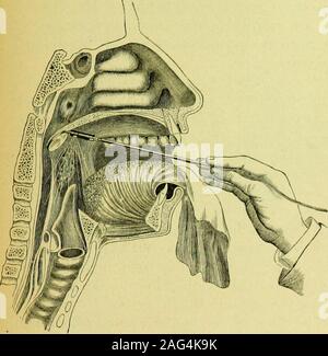 . Medizinische Elektrizität; eine praktische Abhandlung über die Anwendungen der Elektrizität in der Medizin und Chirurgie. Adamss elektrische Laryngoskop. Intensität wie die Atemwege zu beleuchten, um apoint fast eine Zoll unterhalb der Bifurkation. Die sameprinciple kann mit dem otoskop angewendet werden, die Augenchirurgischer - Umfang und andere Instrumente für die Beleuchtung. Dr. Adamsdeserves die größte Anerkennung für sein Geschick und Einfallsreichtum; aber die Mittel, durch die er schlägt thenecessary Menge Strom zu produzieren, der platinumincandescent zu rendern sind bei weitem nicht ausreichend. Durch die Verwendung eines Akkumulators oder von einem der Stockfoto