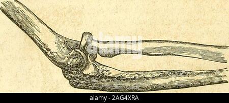 . Die Grundsätze und die Praxis der modernen Chirurgie. Die Behandlung dieser vier Sorten ist das Gleiche. Verringerung kann beeffected,^rs^, indem das untere Ende des Humerus während die Fore-Arm nach vorn gezogen, oder zweitens, der Chirurg kann die elbowforcibly über seine Knie beugen, oder Drittens (wenn der Fall ziemlich neu sein,) Er mayforcibly richten Sie den Arm, um die Sehne des Bizeps pullthe Trochlea des Humerus wieder an seinen Ort. (5) Der Leiter des Radius allein nach vorne verschoben werden kann, beingthrown gegen den äußeren kondylus. Das Knie ist leicht gebeugt, und inbending es mehr Stockfoto