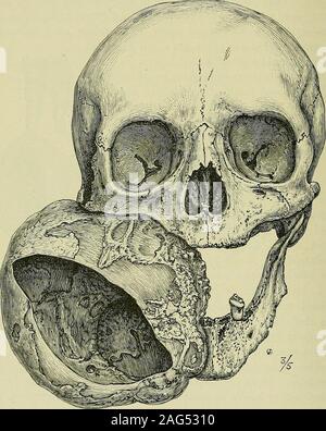 . Tumoren, unschuldig und bösartigen; ihre klinische Zeichen und die entsprechende Behandlung. Abb. 136.- Dentalcysts an den Wurzeln ofa Tot unteren Molaren. 232 ODONTOMAS verbunden mit einem kariösen Zahn, vor allem von langjährigen, eine zahnmedizinische Zyste berücksichtigt werden. Der Verein otthese Zysten mit Kariösen und tote Zähne ist ausreichend, um die Entlüftung von beinsf verwechselt für follicular odontomes.. Abb. 137.- große Zyste mit den Unterkiefer angeschlossen ist; es ist wahrscheinlich eine unusuallylarge zahnmedizinische Zyste. [Muscmn, St. Georges Hosjntal.) Behandlung. - Die Wurzeln müssen gewonnen werden, und der Zyste - Wand gründlich enuclea Stockfoto