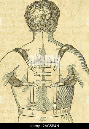 . Die Grundsätze und die Praxis der modernen Chirurgie. Schulter oder das Minderwertige anglewith der Anderen. Behandlung.- eine Rolle muss rund um die Amtsleitung übergeben werden, und ein paar turnsbe gemacht um den Oberarmknochen, um den Arm in die Seite fix und preventall Bewegung. Blutungen, oder auf alle Ereignisse durchgeblasen und niedrigen Diät, wird berequired Entzündung der Brust zu verhindern. Bruch der Hals der Scapula, durch die anoblique Bruch bedeutete, Abbau der coracoid Process und glenoid Hohlraum vom Rest der Knochen, ist eine seltene, Unfall, so sehr, dass einige Chirurgen: seine Existenz zweifeln.* Die beschriebenen Symptome von Sir EIN Stockfoto