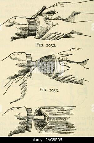 . Die moderne Chirurgie, allgemeine und operativen. Abb. 1031.- Amputation des Armes durch thecircular Methode (druitt). Abb. 1034. Feigen. 1032-1034. Die Schritte von einem transversecircular Amputation (Kocher). Die lanzettlichen Schnitt gebildet wird. Rechteckige Klappen werden gebildet, wenn twolongitudinal Einschnitte mit einem quer eingebauten kreisförmigen Schnitt hinzugefügt werden. Wenn die Eckender rechteckiger Klappe getrimmt sind, abgerundeten Klappen werden gebildet. Die drei zuletzt genannten Pläne sind unter den Kopf der Modifizierten kreisförmigen Ampu- tation (siehe Seite 1554). Stockfoto