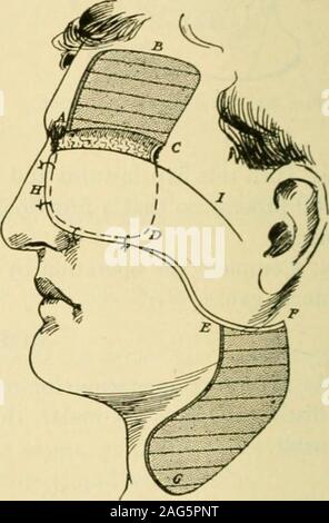 . Handbuch der operativen Chirurgie. Abb. 91. - exzision Nagetier Ulkus. Abb. 92,- Kunststoff Reparatur nach Exzision rodentulcer. T) Rpe der Operation auf die Deformität. Reparatur - Auf die unbehaarte Stirn makethe Schnitt A, B, C, Abb. 92, um so eine Klappe zu bekommen, A, C, D, Größe und shapesuitable Eine epidermale Äußeren und anterioren Wand an der Buchse zu stellen Links byoperation. Die Basisstation (A, C) der Klappe ist ein wenig oberhalb der Orbit und sollte toextend jenseits der Umlaufbahn auf die eine oder andere Seite, um ausreichend ernähren. Die Klappe ist jetzt unten gedreht, so dass die epidermale Oberfläche innen liegt, seine raw-Oberfläche Stockfoto