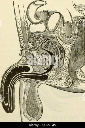 . Die moderne Chirurgie, allgemeine und operativen. Abb. 977.- senns Silber tube. Abb. 978.- Stevensons suprapubicdrainage-Tube. Wucherungen in der weiblichen Blase. - Es war lange der Brauch der urethraas in einem Fall von Stein zu weiten, und Kratzen, Twist, oder das Wachstum weg ziehen oder ligate. Dieser Plan ist ineffizient, wie es die Basis der Tumor nicht entfernt wird. Es ist. Abb. 979.- senns Rohr angewendet. : Dieschrauben drückt nicht auf die Sen- sitive Hals der Blase. Stockfoto