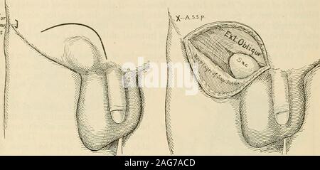 . Die moderne Chirurgie, allgemeine und operative. Fasern, die auftreten können, sind getrennt. Die separatedaponeurosis des externen oblique Muskel wird dann eingefahren. Man hat in den Blick thenbrought der Inhalt Der leistenkanal, der hernial Sac und itsadhesions, der samenstrang, der ilio-Inguinalen Nerv, der interne abdominalring, die subserous Fett, der cremaster Muskel, das siamesische Sehne, die internalobhque und seine mangelhafte Ursprung am Pouparts Ligament, der fascia Transversalis und die innere Oberfläche des Pouparts Ligament. Der sac ist jetzt fromI Annalen der Chirurgie, Nov. 1897 seziert. Trea Stockfoto