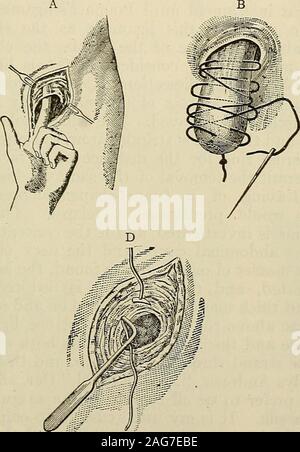 . Die moderne Chirurgie, allgemeine und operativen. Abb. 818.- ein, schwenkbaren Hernie Di-rektor; B, hernie Nadeln.. Stockfoto