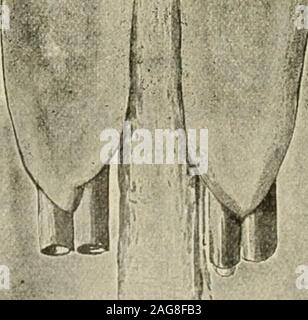 . Die moderne Chirurgie, allgemeine und operativen. Abb. 760.- moynihans Methode der gastro-enterostomy: schräg auf die Anwendung des clampto des Magens (MOYNIHAN). :^^. Stockfoto