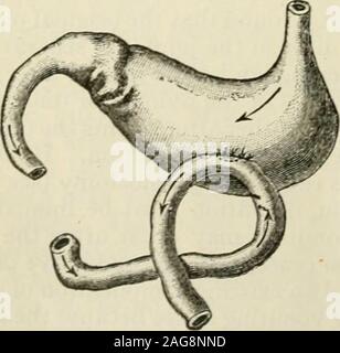 . Die moderne Chirurgie, allgemeine und operativen. Abb. 746.- Billrothsmethod von gastro-enterostomy.. Abb. 74:, - Gastro-enterostomy (afterLucke). Stockfoto