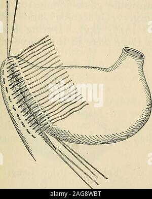 . Die moderne Chirurgie, allgemeine und operativen. Abb. 729.- Finneys pyloroplasty: Der Feigenbaum. 730.^- Finneys ofretractor pyloroplasty; chirurgisches Nahtmaterial Nahtmaterial. Eine stärkere Krümmung der Magen Duodenum.. Stockfoto