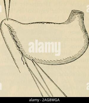 . Die moderne Chirurgie, allgemeine und operativen. Abb. 729.- Finneys pyloroplasty: Der Feigenbaum. 730.^- Finneys ofretractor pyloroplasty; chirurgisches Nahtmaterial Nahtmaterial. Eine stärkere Krümmung der Magen, Duodenum. Stockfoto