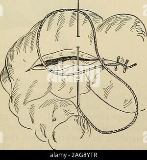 . Die moderne Chirurgie, allgemeine und operativen. Abb. 718.-^ Lemberts Naht geschlossen. Abb. 719.- Cushings rechtwinklige Naht (Senn). Stockfoto