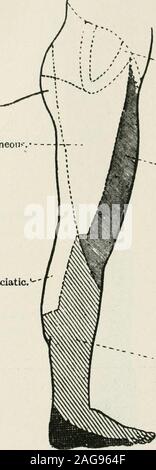 . Medizinische und chirurgische Therapie. Externe Anwendung auf der Haut. Kleine "fiiatio. ? Externe Poplitea. Interne Poplitea. Fio. 70.- periphere sensorische Verteilung der unteren Extremität (posterior Aspekt). Der peroneus hrevis entführt und everts den Fuß. Schließlich ist der extensor digitorum hrevis unterstützt die extensor Longus, und erweitert die ersten Phalangen der ersten vier Zehen. Muskeln von den internen Poplitea Nerv. - Die popUtetismuscle biegt sich das Bein auf den Oberschenkel. Die plantaris ist sehr unbeständig und hat keine besondere Aktion. Der Gastrocnemius und Soleus vereinen einen einzigen Muskel zu bilden, der Trizeps o Stockfoto