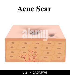 Atrophische Narben. Akne Narbe. Die anatomische Struktur der Haut mit Akne. Vector Illustration auf isolierte Hintergrund. Stock Vektor