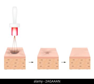 Aknenarben. Laser Narben atrophische Behandlung. Die anatomische Struktur der Haut mit Akne. Vector Illustration auf isolierte Hintergrund. Stock Vektor