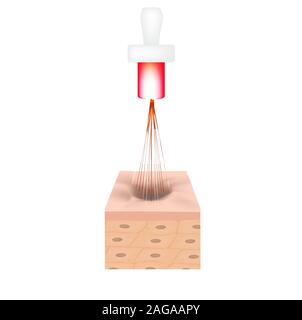 Aknenarben. Laser Narben atrophische Behandlung. Die anatomische Struktur der Haut mit Akne. Vector Illustration auf isolierte Hintergrund. Stock Vektor