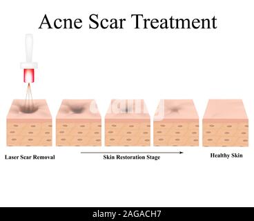 Aknenarben. Laser Narben atrophische Behandlung. Die anatomische Struktur der Haut mit Akne. Vector Illustration auf isolierte Hintergrund. Stock Vektor