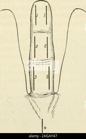 . Die moderne Chirurgie, allgemeine und operative. ing toopening und Entleeren. Wenn die thekazellen der Daumen oder Finger beteiligt ist, opendistally und dann nach proximal über dem Handgelenk. Zu erreichen das proximale Ende der Theka der Daumen Schnitt an der radialen Seite der Sehne des flexor carpiradialis. Öffnen Sie zusätzlich die Palmar sac Der flexor longus Pollicis, wodurch die cutalong der inneren Grenze der äußeren Leiter der flexor pollicis Brevis. Zu den proximalen Ende der thekazellen des kleinen Fingers erreichen beginnen eine incisionat den oberen Rand der ringförmigen Ligament und entlang der innerborder des Fl Stockfoto