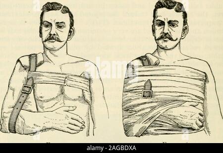 . Die moderne Chirurgie, allgemeine und operative. Hno, und sutur-ing Die schulterdach auf dem äußeren Ende des Schlüsselbeins. Die Knochen sind vernäht withsilver Draht oder Känguru sehne, die withcatgut acromioclavicular Ligament ist genäht, die Wunde mit Naht der silkworm geschlossen ist - gut, und der Patient in der Rückenlage im Bett iskept für drei Wochen. Ich habe erfolgreich auf 5 von thesecases betrieben. Verschiebung nach unten reduziert und in der gleichen Weise behandelt wie Dis-Position nach oben. Die gleichzeitige Verlagerung von beiden Enden des Schlüsselbeins ist eine sehr seltene Verletzung. Itis behandelt wie einzelne dislokation. Die so genannten Dislokation Stockfoto