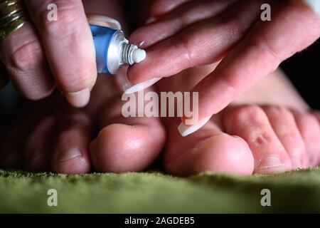 Finger appling Lotion zu Fuß mit Pilzbefall. Althele den Fuß können zu schweren Juckreiz, Bläschen, reddness und stinkenden Füße verursachen Stockfoto