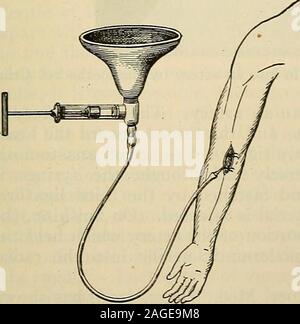 . Die moderne Chirurgie, allgemeine und operativen. Abb. 272.- die intravenöse Infusion von Kochsalzlösung. Weise ofincising Vene und Einsetzen von Glas Rohr (Senn). Stockfoto