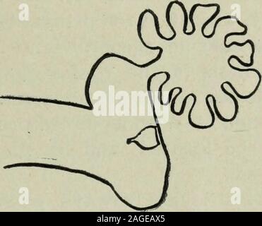 . Plexus. Abb. 1. Schematische Darstellung der Abb. 2. Das Trommelfell, Hammer Mittelohr antrum und mastoid und Amboss entfernt freecells zu erleichtern. Entwässerung der Dachboden und Antrum. Leiter der Hammer und Amboss, zusammen mit den Bändern andfibrous Bands, die Sie unterbrechen, Form der Boden der Dachboden orroof des Mittelohrs. Es ist zwar richtig, dass wenn theattic beteiligt ist, ist es in der Regel einer Perforation durch themembrana flacid flacida (oberer Teil des Trommelfell), Es isusually klein und lässt nicht zu, dass der freien Abfluss. Nekrose der Leiter der amboss oder Hammer ist Stockfoto