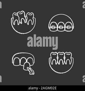 Zahnheilkunde chalk Symbole gesetzt. Stomatologie. Schief und gesunde Zähne, Zahnspangen, Furnier. Isolierte vektor Tafel Abbildungen Stock Vektor