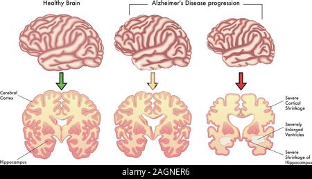 Medizinische Illustration der Alzheimer Erkrankung. Stock Vektor